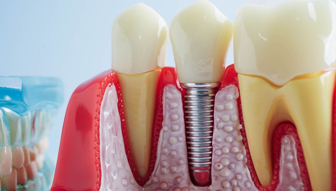 Common Signs You Need a Root Canal Treatment