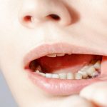 Gum Grafting Surgery