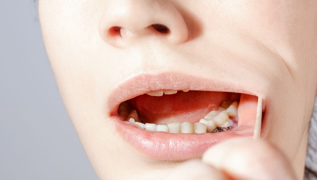 Gum Grafting Surgery