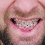 How to Care for Your Braces